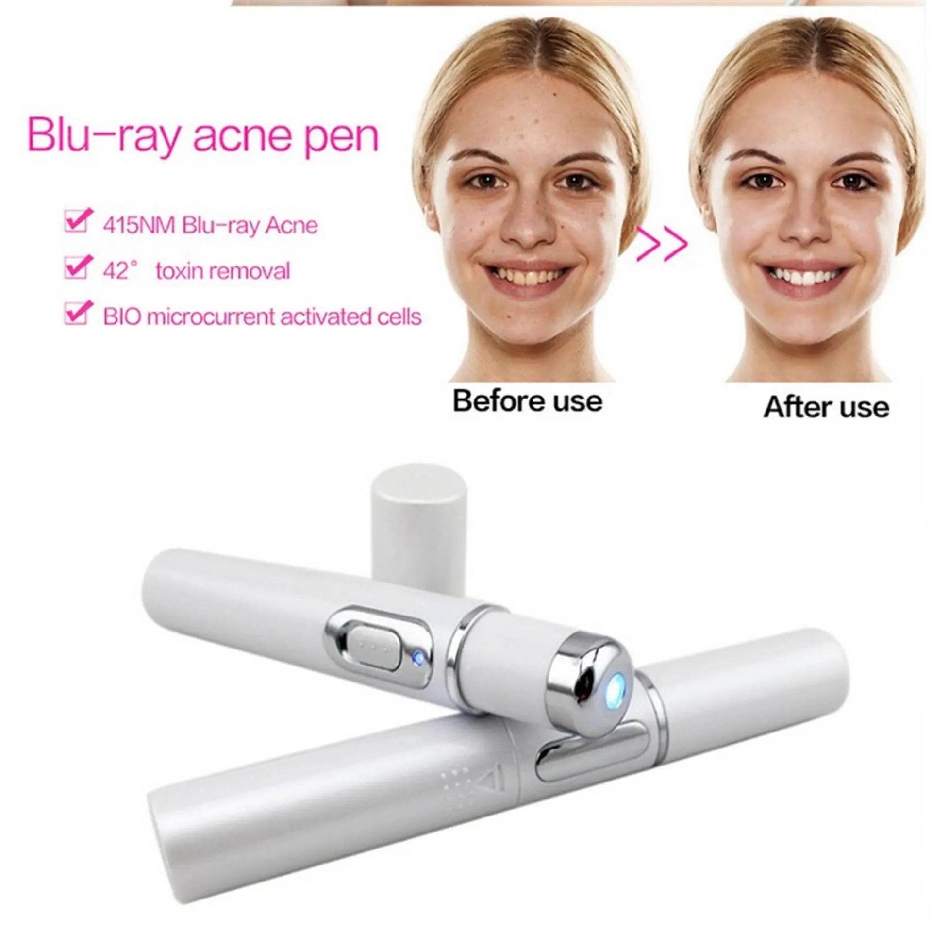 Blue Light Therapy Acne Laser Pen Soft Scar Wrinkle Removal Treatment Device Skin Care Beauty Equipment - ProTrendyz
