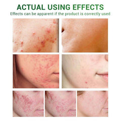 Acne Treatment Serum Facial Repair Oil - ProTrendyz