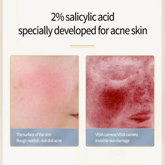 Acne Removing Salicylate Products - ProTrendyz