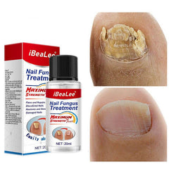 Thickening Of Special Bacteriostatic Liquid For Onychomycosis - ProTrendyz