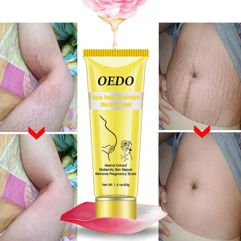 Rose go to stretch marks cream for Pregnancy Fat Belly Growth - ProTrendyz