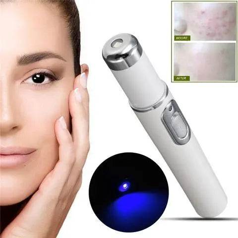 Blue Light Therapy Acne Laser Pen Soft Scar Wrinkle Removal Treatment Device Skin Care Beauty Equipment - ProTrendyz