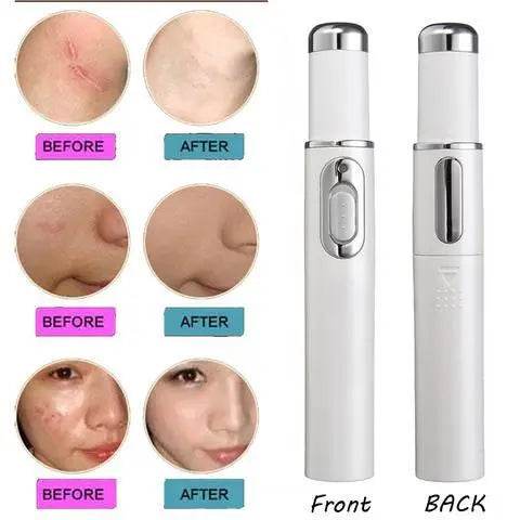 Blue Light Therapy Acne Laser Pen Soft Scar Wrinkle Removal Treatment Device Skin Care Beauty Equipment - ProTrendyz
