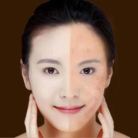 Blue Light Therapy Acne Laser Pen Soft Scar Wrinkle Removal Treatment Device Skin Care Beauty Equipment - ProTrendyz