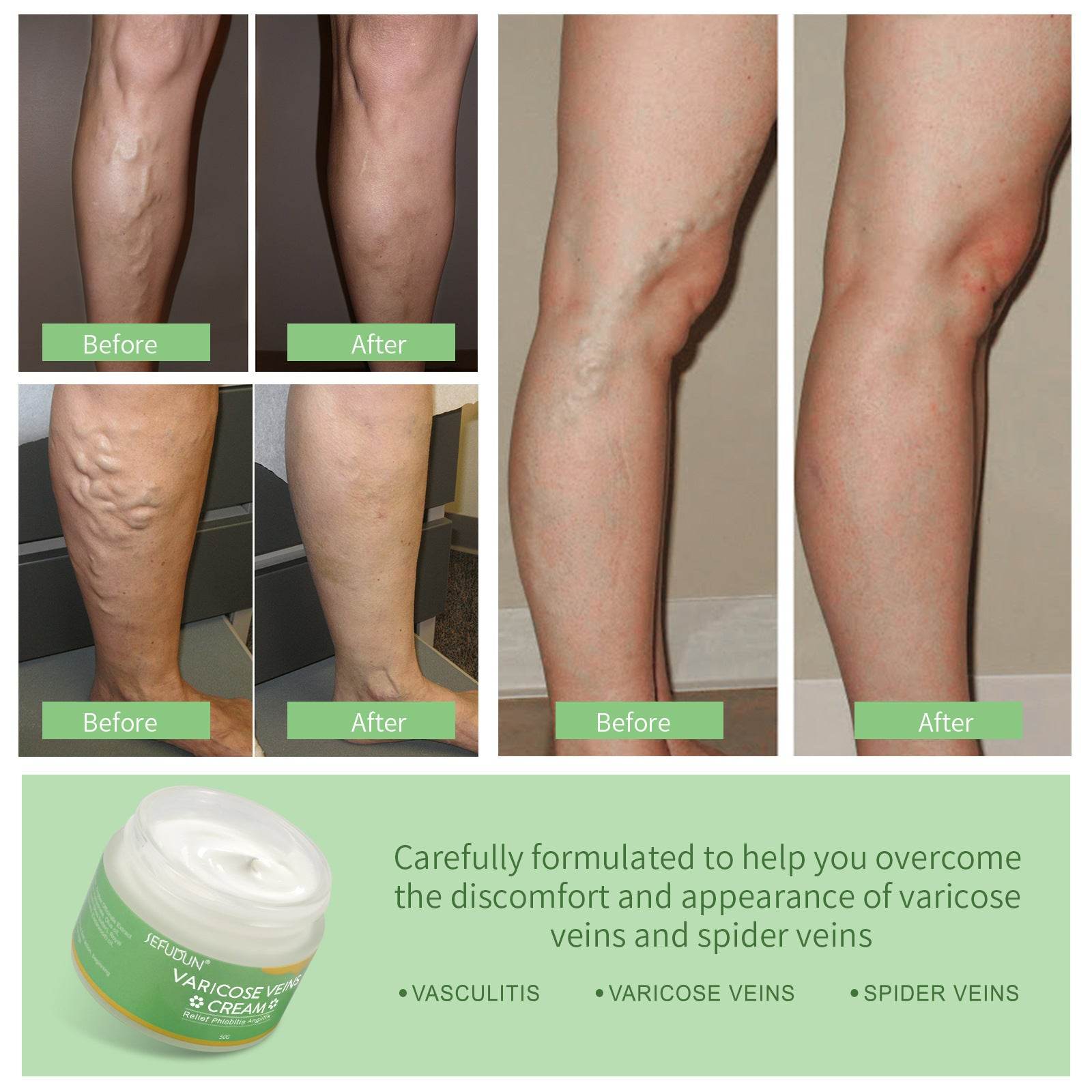 Vein Cream Red Blood Streaks Repair Earthworm Leg Bruises Bulge Relief Pain Safflower Skin care lotion Varicose Cream - ProTrendyz