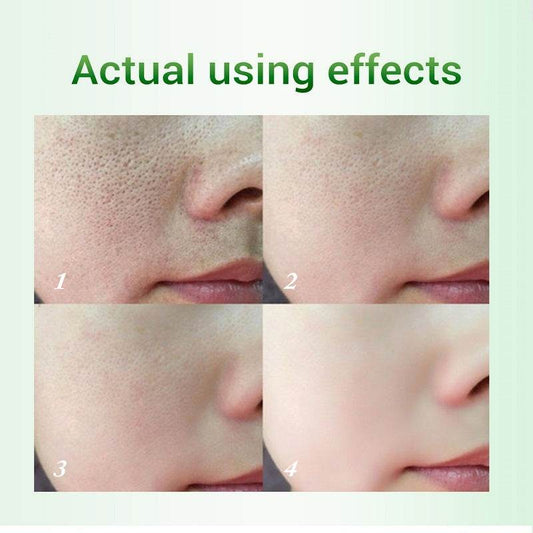 Salicylic Acid Pore Refinement Cream Lotion Skin Rejuvenation Cream Skin Care Products - ProTrendyz